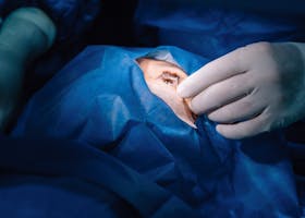 A surgeon's hand performing a procedure on a patient's eye in a sterile operating room environment.