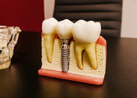 Ceramic dental implants with bolt in artificial mouth piece on desktop in hospital