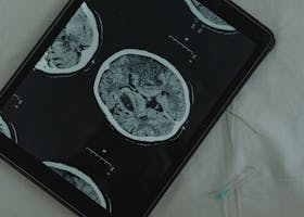 Close-up view of a brain CT scan displayed on a digital tablet with a medical needle beside it.